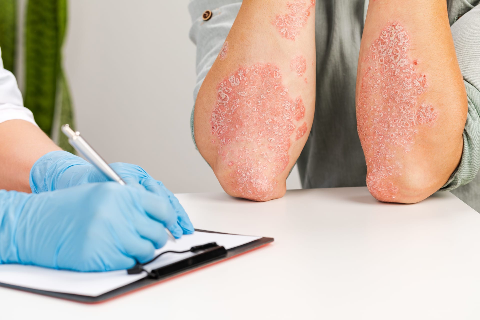 um-dermatologista-enluvado-examina-pele-de-um-paciente-doente-e-registra-observacoes-exame-e-diagnostico-de-doencas-de-pelealergias-psoriase-eczema-dermatite (1)