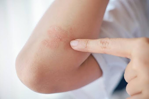 Alergia a poeira